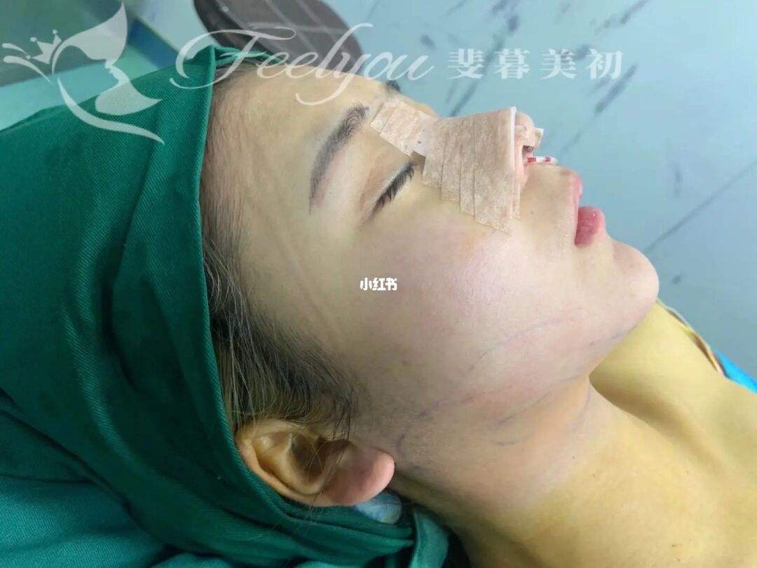 鼻综合文案(医美鼻综合文案)